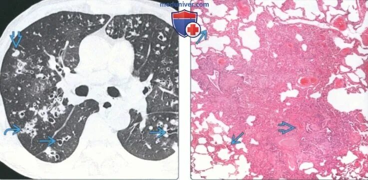 Облитерирующий бронхиолит на кт. Рентгенограмма микоплазменной пневмонии. Картина дерева в почках на кт легких. Туберкулез бронхиолит кт. Экссудативный бронхиолит.