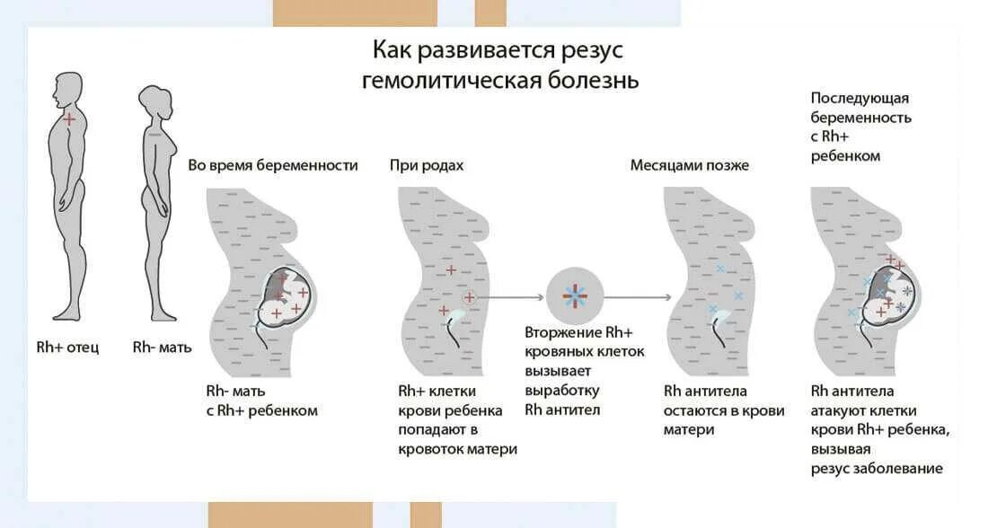 Кровь 1 отрицательная беременность. Последовательность стадий развития резус- конфликта. Схема резус конфликт при беременности. Конфликт по резус фактору при беременности. Механизм развития резус конфликта.