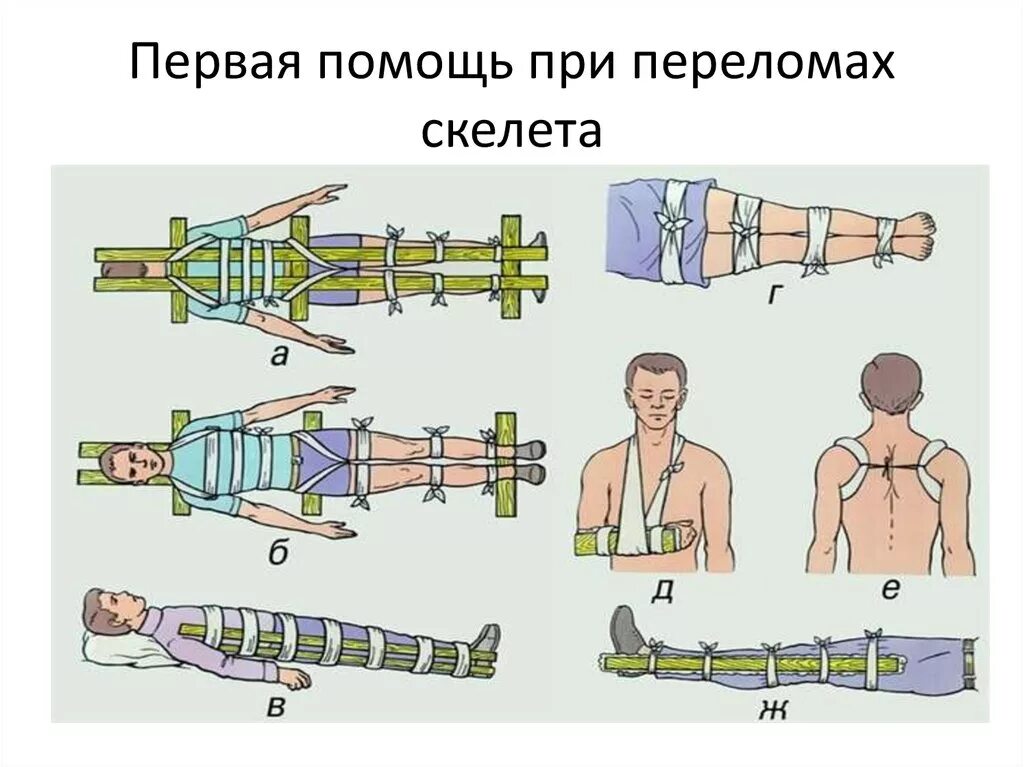Переломы костей конечностей действия по оказанию первой помощи. Оказание 1 помощи при вывихах и переломах. Перелом костей первая медицинская помощь. Правила оказания первой помощи при переломах. Первая помощь при пере.