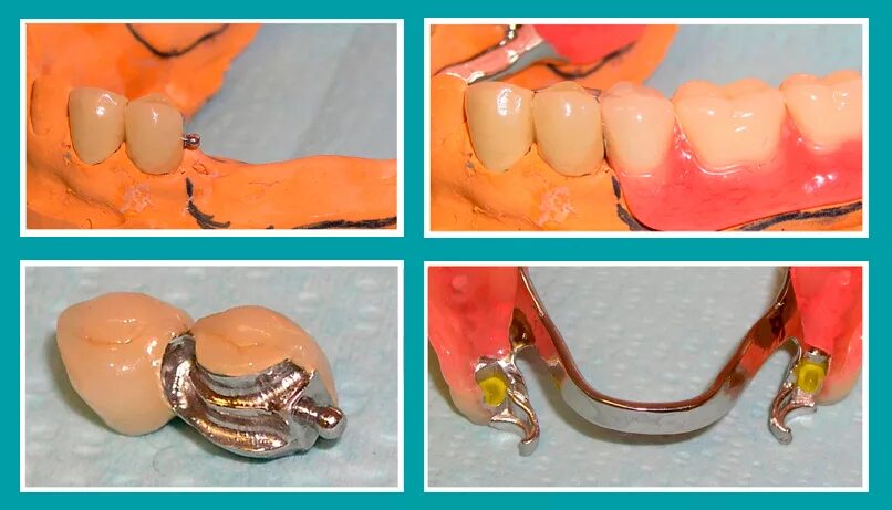 Бюгельный протез кламмерный (remanium-700). Бюгельный протез а16.07.036.002. Бюгельный микропротез на 2 зуба. Как крепятся съемные