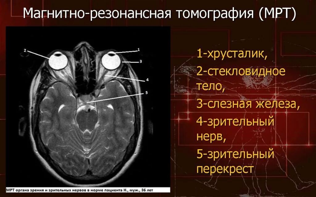 Глазных орбит и зрительных нервов. Анатомия зрительного нерва мрт. Анатомия глазного яблока мрт. Зрительный нерв анатомия кт. Мрт глазных орбит и зрительных нервов норма.