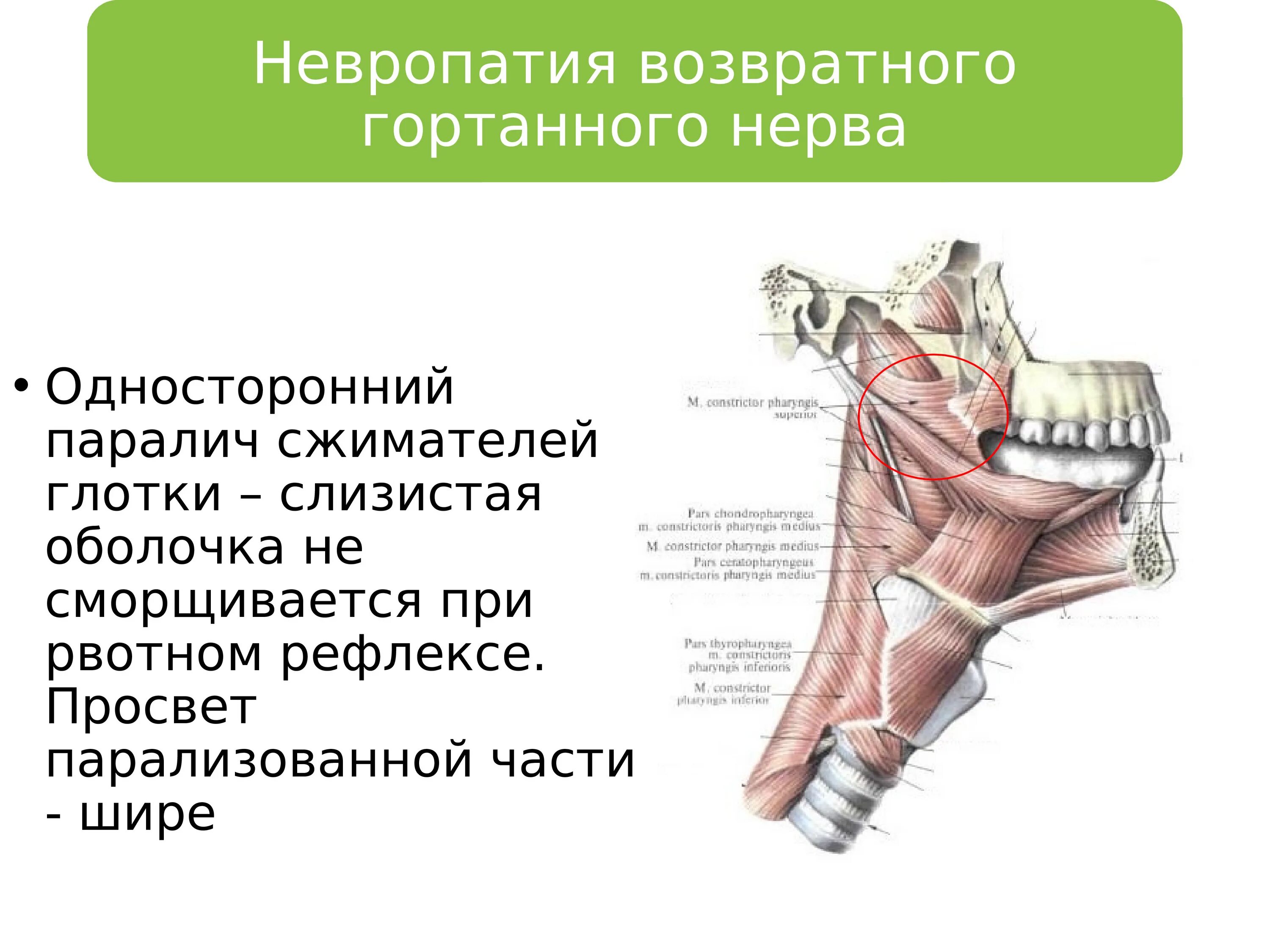 Поражение возвратного нерва. Повреждение возвратного гортанного нерва симптомы. Парез возвратного гортанного нерва.