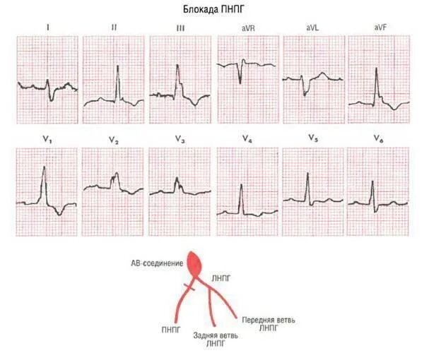 Блокада пучка гиса на экг у ребенка. Расщепление комплекса QRS В v1. Раздвоение QRS на ЭКГ. Блокады ножек пучка Гиса в 3 отведении. М образный зубец s на ЭКГ.