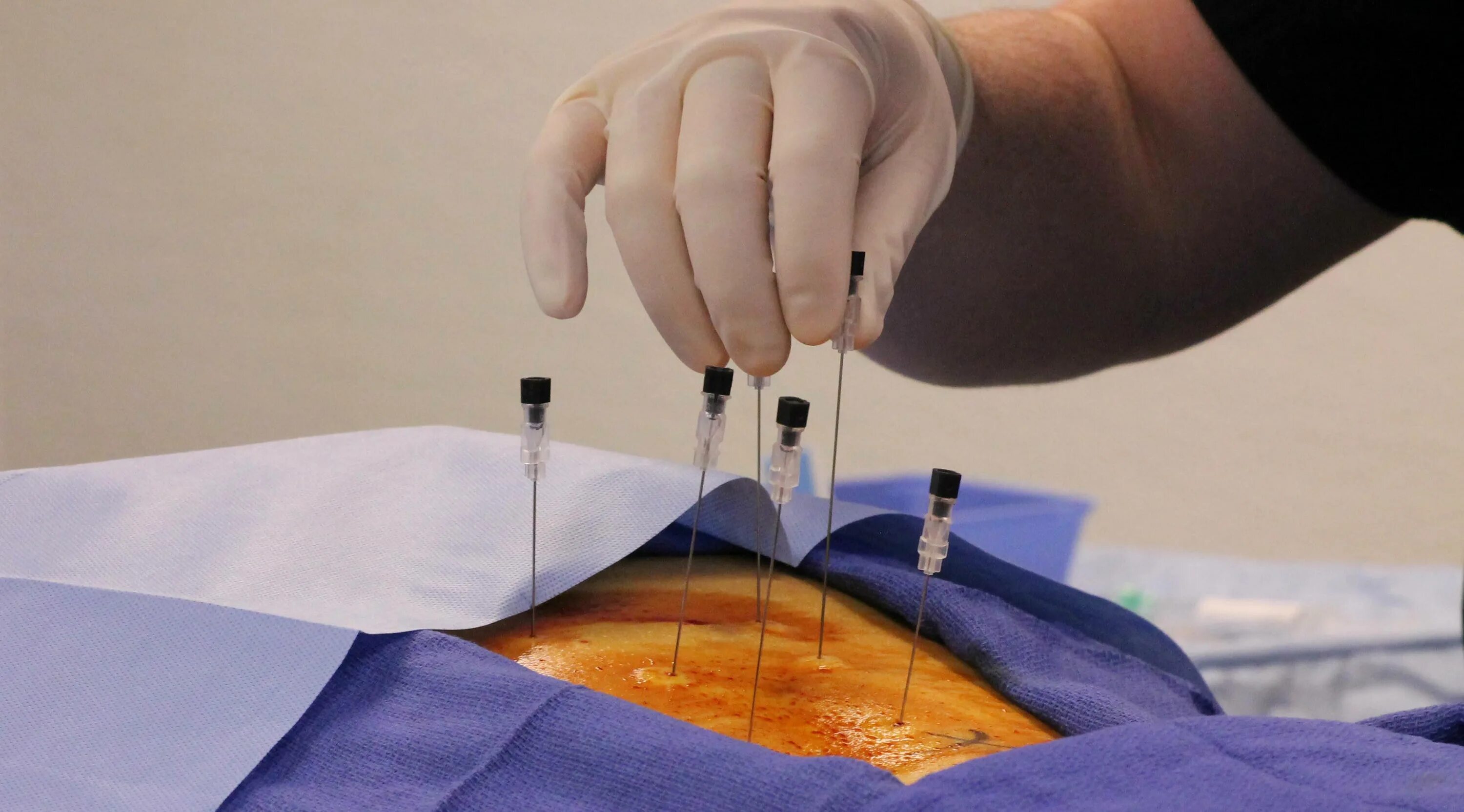 Рча фасеточных суставов. Радиочастотная деструкция фасеточных суставов. Радиочастотная денервация фасеточных суставов позвоночника. Рча фасеточных нервов поясничного отдела позвоночника. Радиочастотная денервация суставов позвоночника.