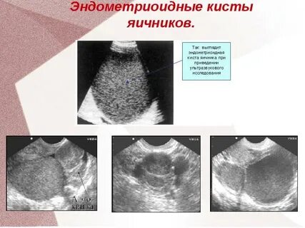 Эндометриоидные кисты отзывы форум