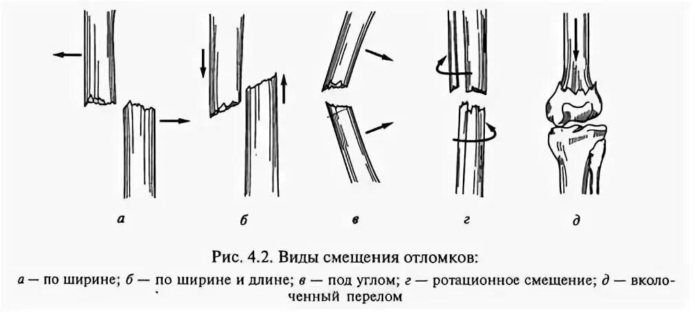 Перелом со смещением нужна операция. Перелом со смещением костных отломков. Репозиция костных отломков классификация. Виды смещения костных отломков при переломе. Смещение отломков при переломе.