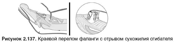 Перелом фаланги мкб 10. Краевой перелом ногтевой фаланги. Шов сухожилий сгибателей кисти. Краевой перелом ногтевой фаланги пальца руки. Остеосинтез ногтевой фаланги.