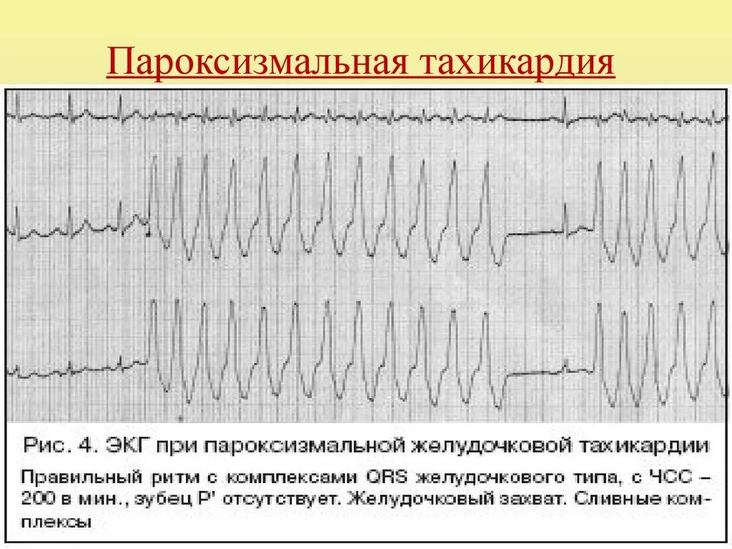 Пароксизмальная тахикардия на экг