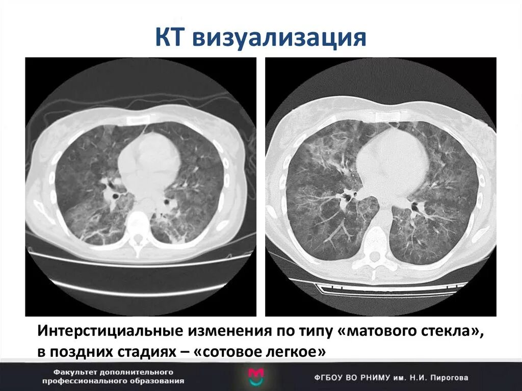 Интерстициальная пневмония на кт. Что такое матовое стекло в легких на кт при коронавирусе. Очаги по типу матового стекла кт. Легкие на кт при коронавирусе и пневмонии.