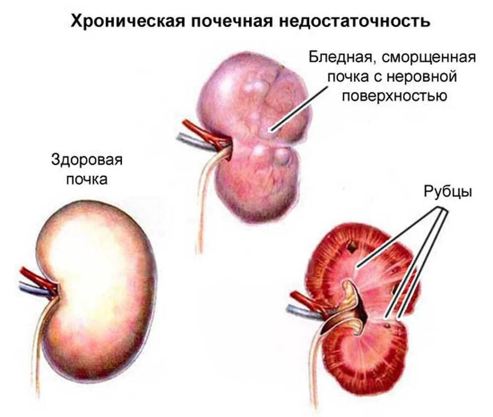 Почему плохие почки