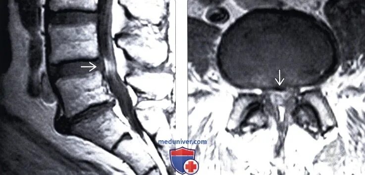 Поясничный абсолютный стеноз. Стеноз дурального мешка мрт. Стеноз поясничного отдела мрт. Стеноз позвоночного канала поясничного отдела мрт. Стеноз спинномозгового канала мрт.