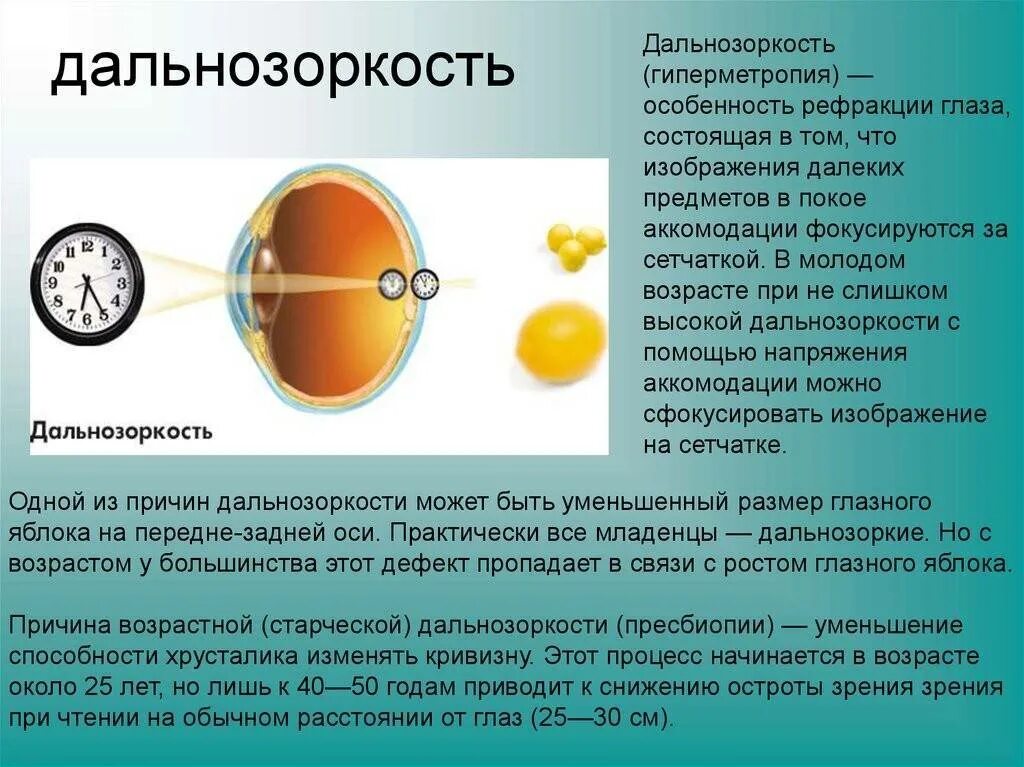 Гиперметропия средней степени глаза. Миопия дальнозоркость астигматизм. Гиперметропия высокой степени рефракция. Дальнозоркость (гиперметропия). Заболевание дальнозоркость.