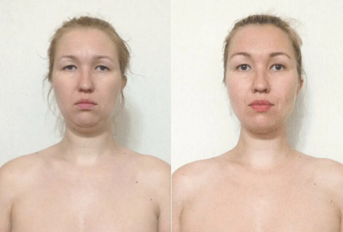 Одутловатость лица это. Одутловатость лица это. Пастозность (одутловатость) лица. Гипотиреоз одутловатое лицо. Одутловатость лица это.