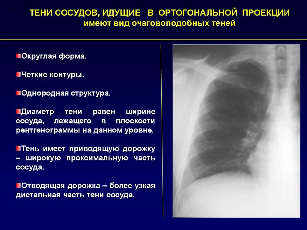 Округлыми формами в легком. Тени сосудов на рентгене легких. Сосуды в ортогональной проекции на рентгене.