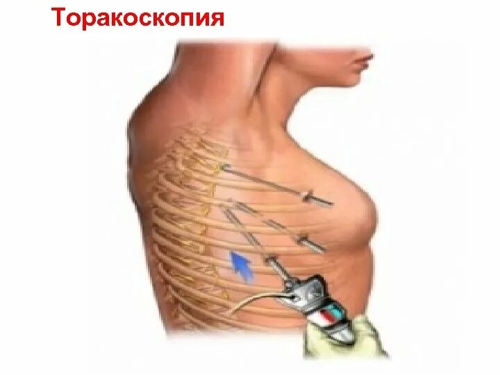 Реабилитация после операции на легком. Торакотомия и торакоскопия. Торакоскопическая биопсия легкого. Торакоскопия операция.