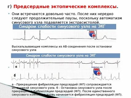 Экг автоматизм