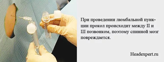 Как берут пункцию мозга. Спинально мозговая пункция. Пункция спинного мозга грудной прокол. Люмбальная спинномозговая пункция.