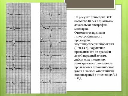 Что означает умеренное изменение миокарда