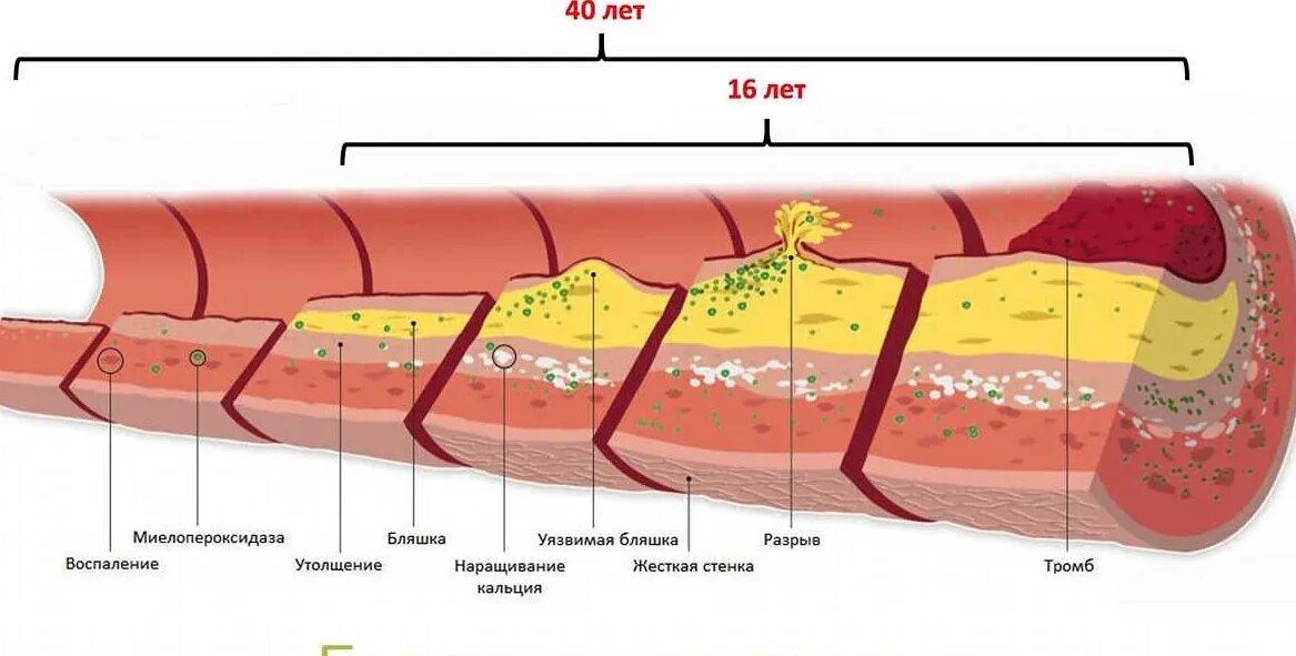Ишемическая стадия атеросклероза. Атеросклероз коронарных артерий стадии и степени. Атеросклероз венечных артерий стадии и степень. Атеросклероз венечных артерий сердца. Тромб и бляшка разница