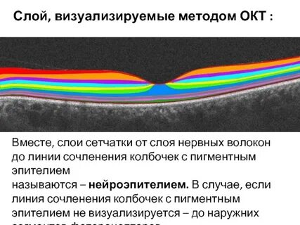 Слой нервных волокон сетчатки