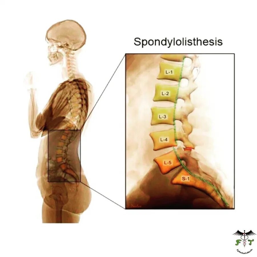 диски позвонков l1-l2,l2-l3,l3-l4,l4-l5. позвонки l1 l2 где находится. L5 s2 позвонки. строение позвоночного столба 1 отдела. диск сегмента l4-l5.