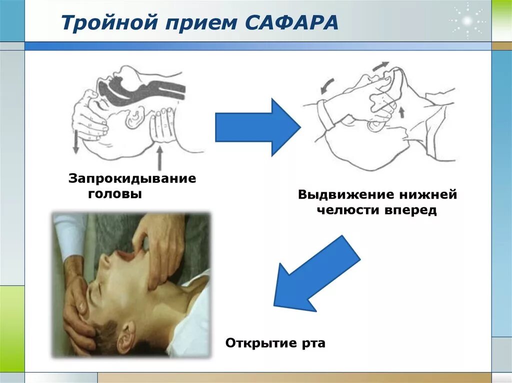 Выдвижение вперед. Слр тройной прием сафара. выдвижение нижней челюсти при реанимации. выдвинуть челюсть вперед прием сафара.