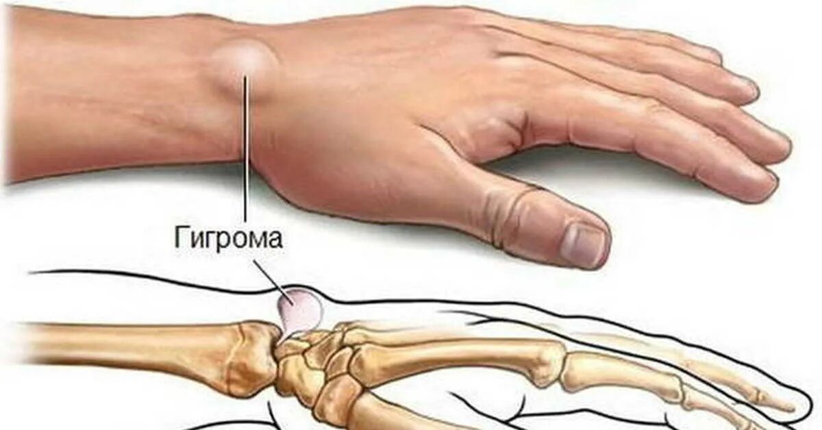 Гигрома лучезапястного сустава. Гигрома лучезапястного СУСТАВF. Синовиальная киста сухожилия.