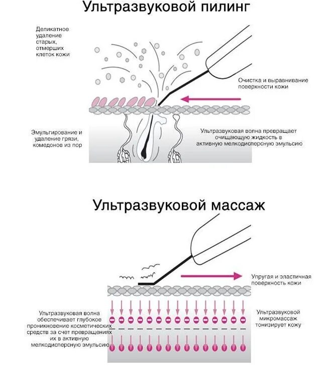 Ультразвук как пользоваться. Аппарат ультразвукового пилинга nova newface nv-232a. аппарат уз пилинга и уз терапии (фонофорез) nova newface nv-233a. схема работы ультразвуковой чистки лица. принцип работы ультразвуковой чистки лица.