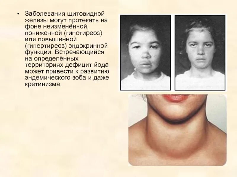 Щитовидная железа йод фтор. Патология щитовидной железы. Гипотиреоз. Гипертиреоз щитовидной железы. Гипотиреоз дефицит йода.