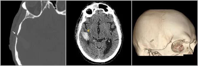 перелом теменной височной кости