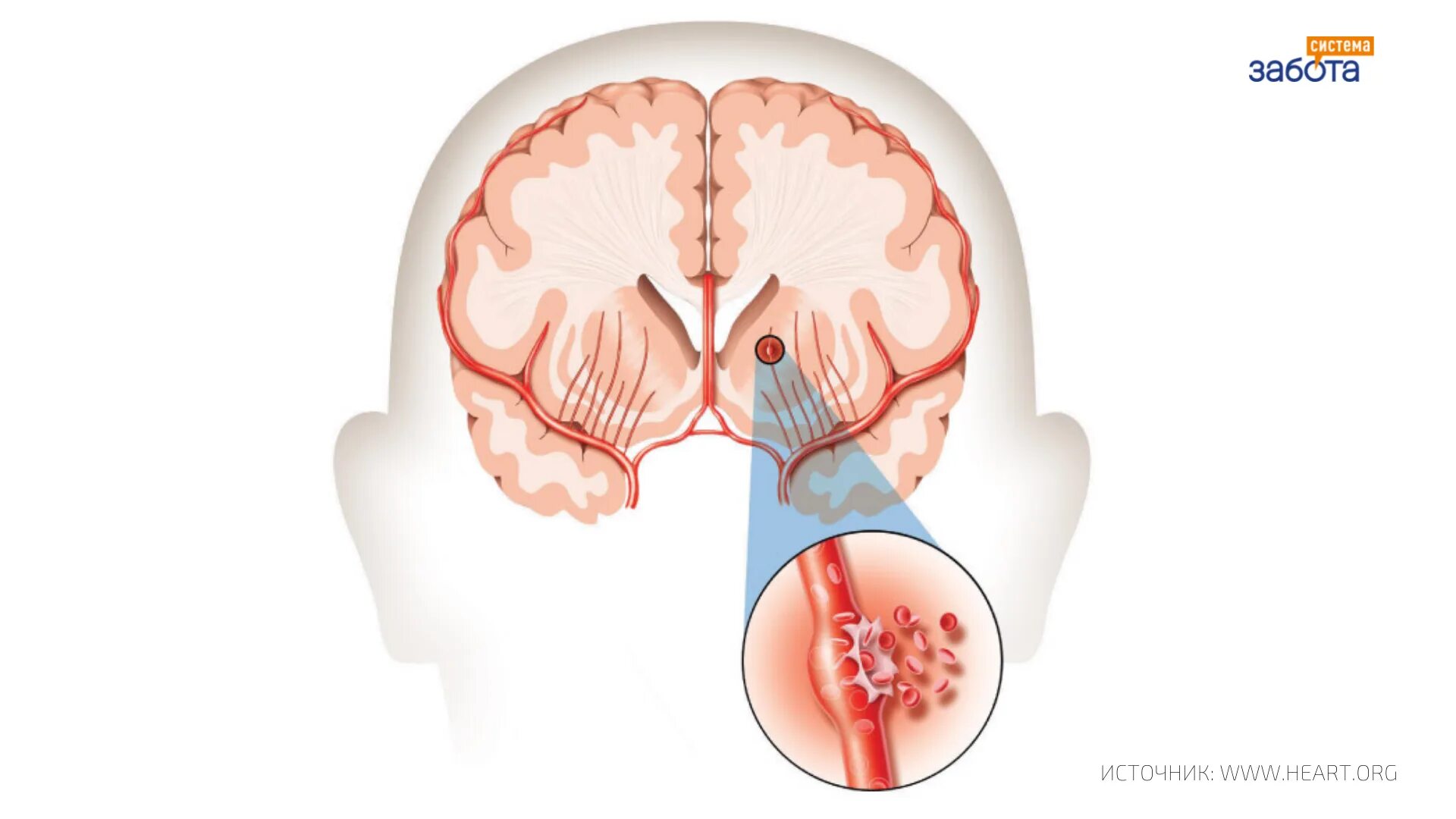 Лечение мозга после инсульта. Геморрагический инсульт головного мозга. Причины геморрагического инсульта головного мозга.