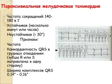 Тахикардия частота