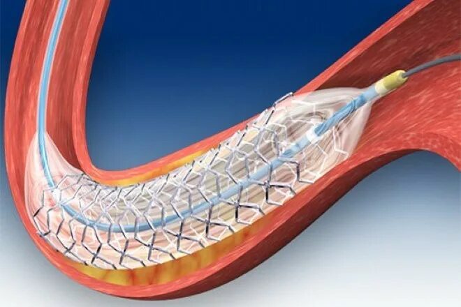 Болит стент. Рассасывающийся стент. Стент SUPRAFLEX.