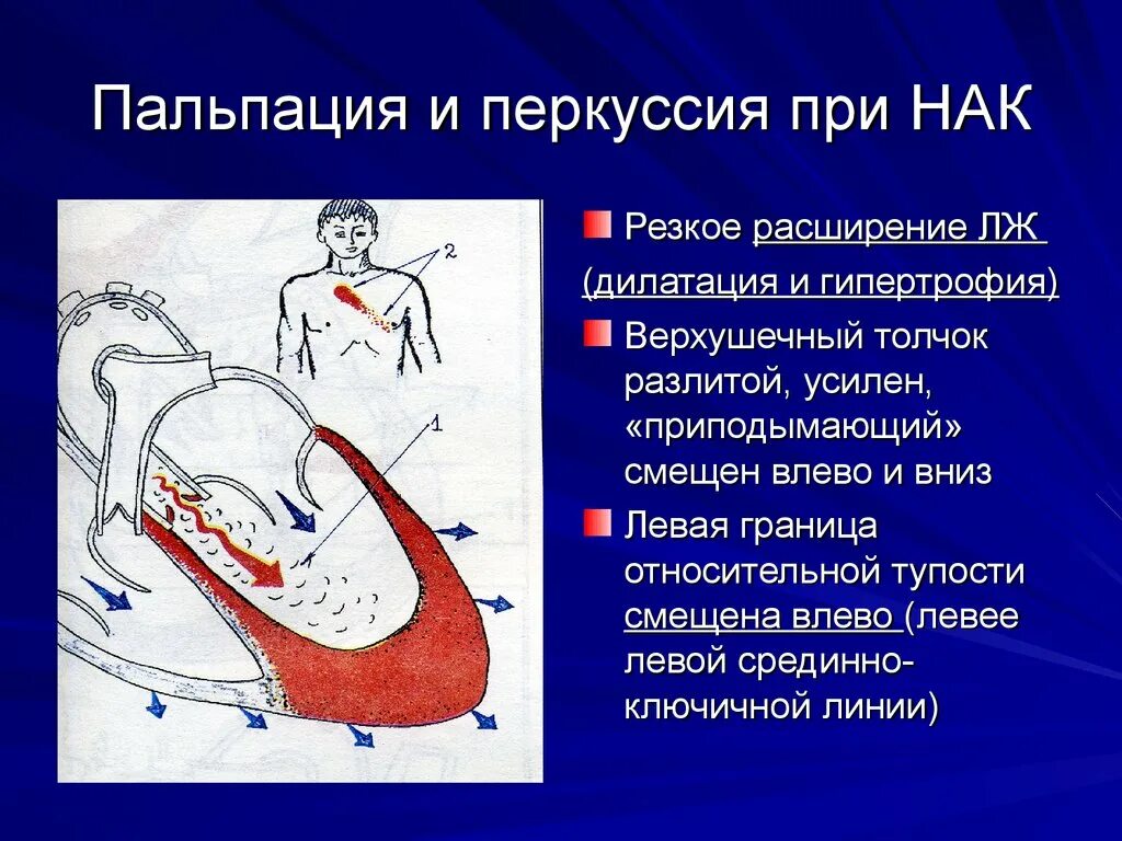 Верхушечный толчок при гипертрофии