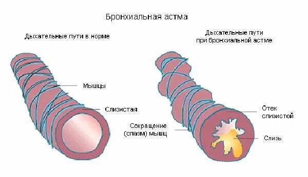 Бронхиальная астма отек легких. Бронхиальная астма. Дыхательные пути при бронхиальной астме. Легкие при бронхиальной астме. Бронхиальная астма у животных.