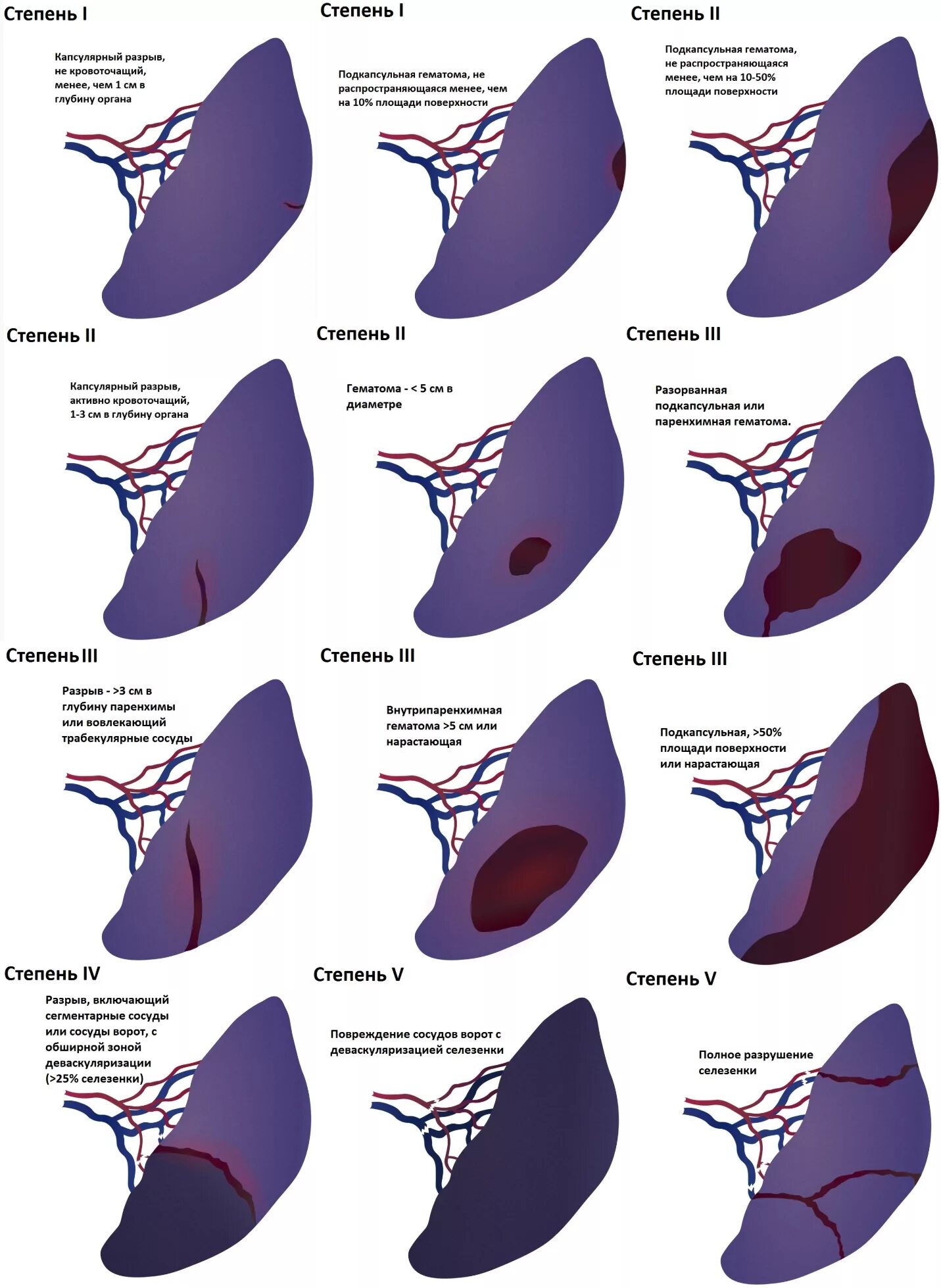 Спленэктомия что это. Симптомы подкапсульного разрыва селезенки. Клиника подкапсульного разрыва селезенки. Гематома селезенки классификация. Подкапсульный разрыв селезенки кт.