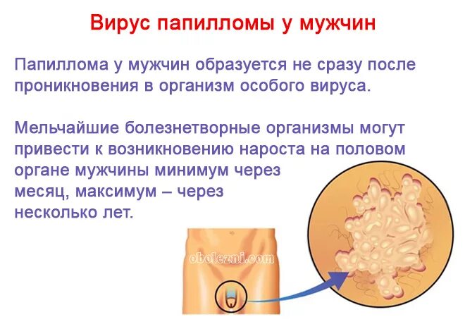 Как вылечить вирус папилломы человека. Венерические кондиломы бородавки. папиллома папилломавирус. кондиломы при впч у мужчин. аногенитальные остроконечные кондиломы.