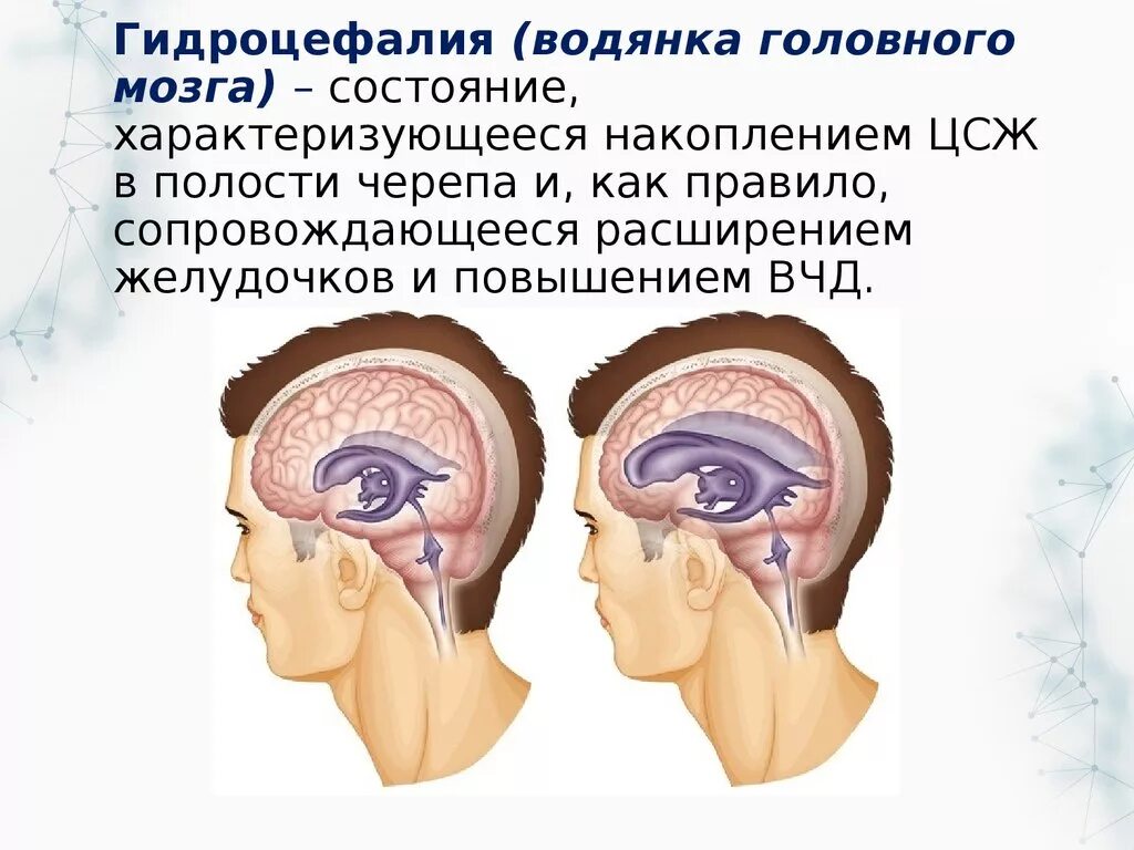 Как лечить гидроцефалию мозга. Гидроцефалия водянка головного мозга. Мультилокулярная гидроцефалия. Гидроцефалия головного мозга у ребенка. Гидроцефалия головного мозга у взрослого.