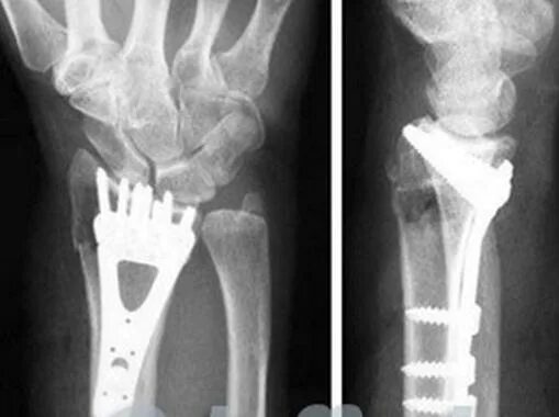 перелом луча в типичном месте рентген. перелом лучевой кости рентген заключение. оскольчатый перелом лучезапястного сустава. остеосинтез перелома лучевой кости. осложнения после лучевого перелома.