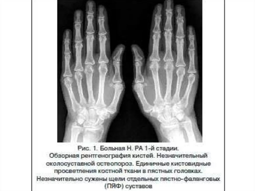 Артрит рентгенологические стадии. Ревматоидный артрит степени рентген кистей. Ревматоидный артрит 4 стадия рентген. Рентген стадии ревмат артрита. Ревматоидный артрит 1 стадия на рентгене.