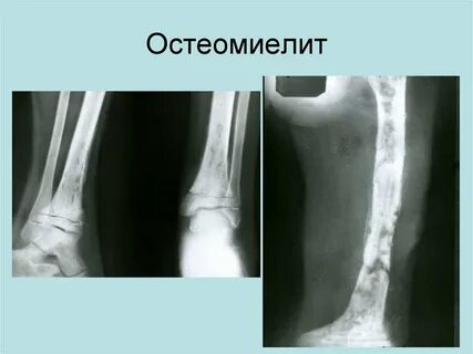 Острый остеомиелит признаки