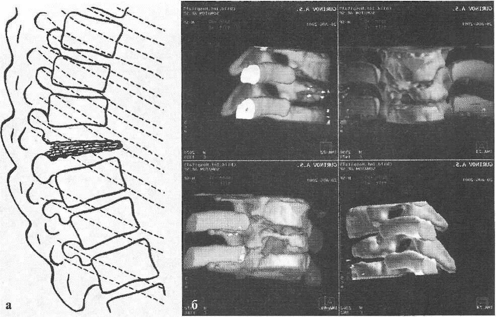 Болезнь кальве у детей. Болезнь кальве у детей. Юношеская остеохондропатия. Болезнь кальве позвоночника на рентгене. Остеохондропатия позвонка кальве.