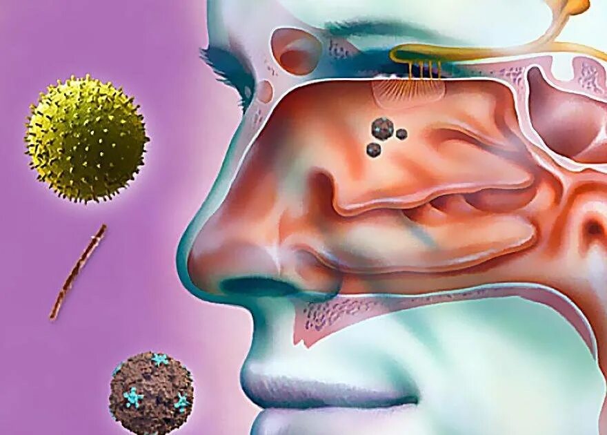 Бактериальный риносинусит. Отличие ринита и синусита. Вирусные сопли. Вирусные сопли. Аллегргически йкашель.