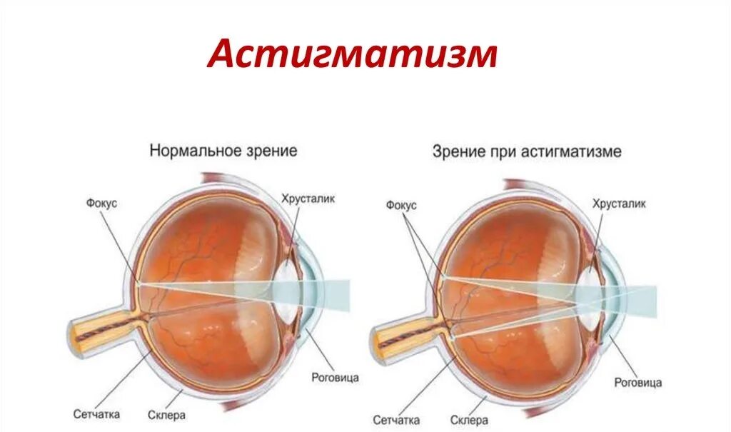 Миопия гиперметропия астигматизм. Астигматизм -3.5. Очки миопический астигматизм -2. Склеропластика при миопии. Почему при боковом зрении хорошо видна