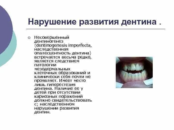 Синдром дисплазии соединительной ткани. Заболевания связанные с эндокринной системой. Неправильное развитие тканей 9 букв. Проявления дисплазии соединительной ткани. Аномалии прикуса открытый прикус.