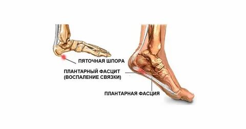 Боль в стопе с внешней стороны сбоку