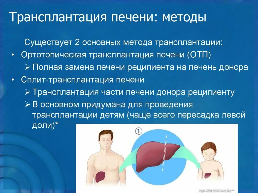 Трансплантация печени. Трансплантация печени методика. Трансплантация печени операция. Трансплантация печени схема.