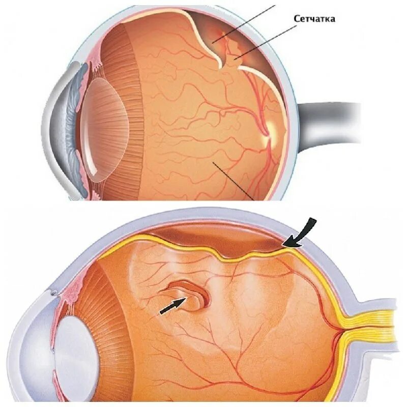 Причины возникновения отслойки сетчатки. Отслойка сетчатки это. Первичная отслойка сетчатки этиология. Отслойка сетчатки глаза симптомы. Макулярная отслойка сетчатки.