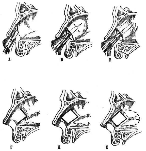Сколько перегородок в носу. Подслизистая резекция носовой перегородки. Подслизистая резекция носовой перегородки ход операции. Септопластика, подслизистая резекция носовой перегородки. Редрессация носовой перегородки.