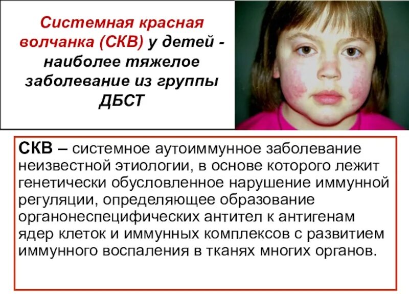 Красная волчанка у детей фото
